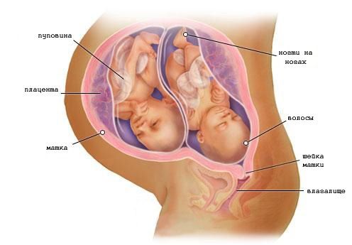 Беременность двойней на 33 неделе (фото)