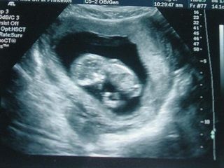 УЗИ 12 неделя беременности 1