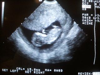УЗИ 11 неделя беременности 1