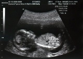 УЗИ 14 неделя беременности