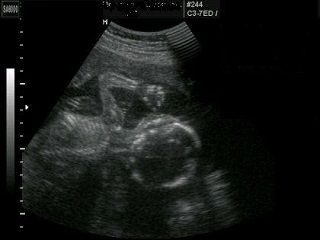 УЗИ 19 неделя беременности 1