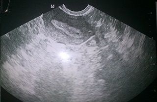 УЗИ 2 неделя беременности 1