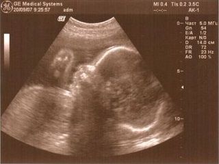УЗИ 27 неделя беременности 1