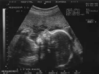 УЗИ 28 неделя беременности 1