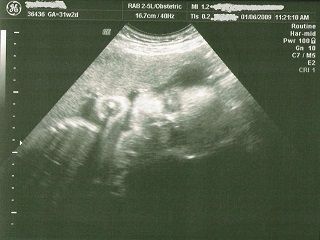 УЗИ 31 неделя беременности 1