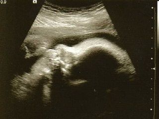 УЗИ 33 неделя беременности 1