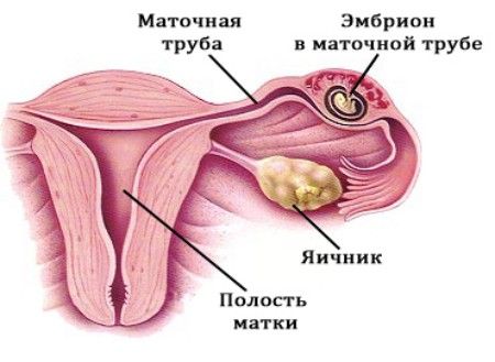 Внематочная беременность 2