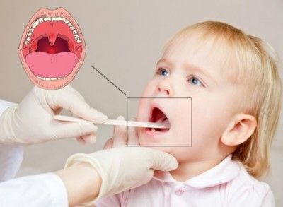 Чем лечить красное горло и температуру у ребенка