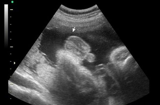 Фото узи в 30 недель беременности мальчика