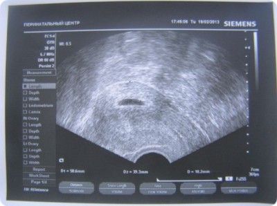 Фото УЗИ на 5 неделе 1