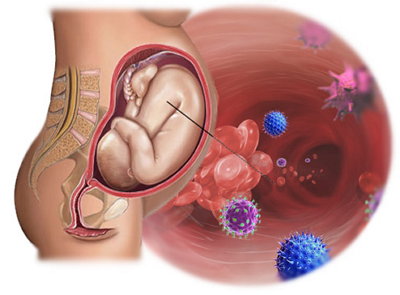 Внутриутробная инфекция при беременности и у новорожденного